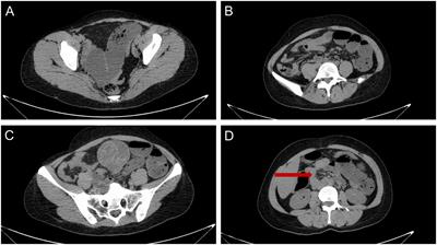 Case Report: Laparoscopy-assisted resection for intra-abdominal gossypiboma masquerading as a jejunal tumor (with video)